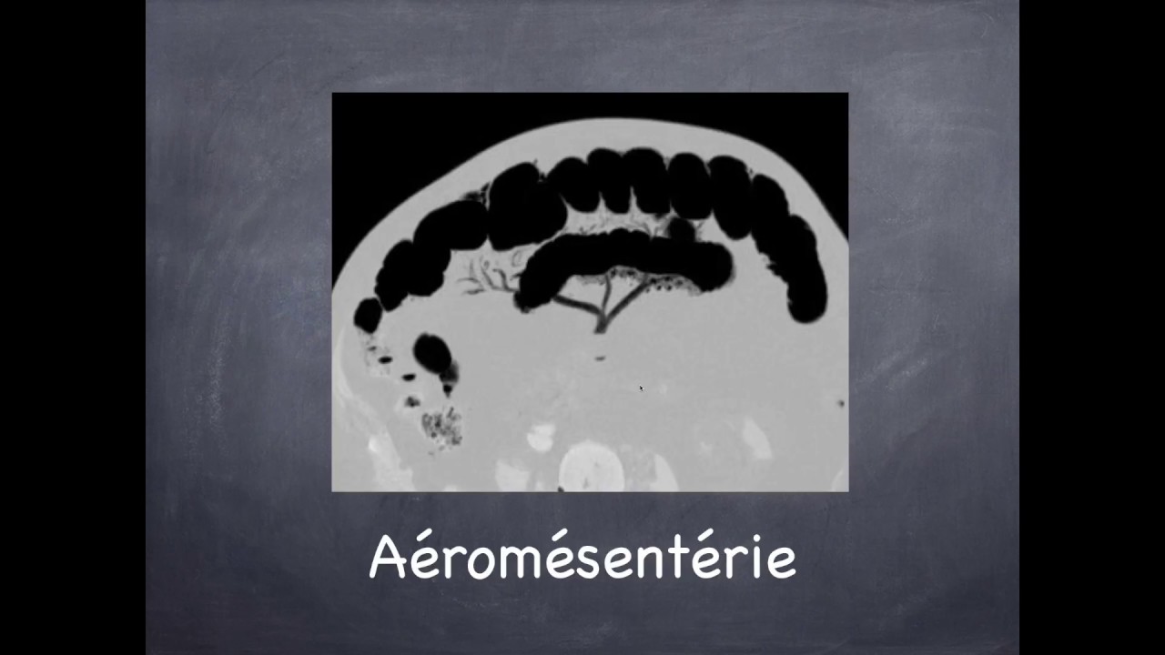 Douleurs abdominales - Ischémie mésentérique