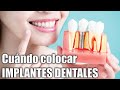 ¿CUÁNDO colocar IMPLANTES DENTALES? 🦷 IMPALTES DENTALES de TITANIO 🦷 Dr. JOSÉ NAVARRO / SAVA SANA