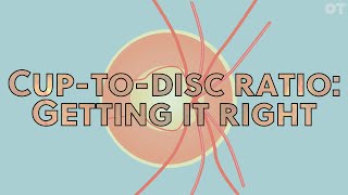 Cup-to-disc ratio: getting it right | OT Skills Guide