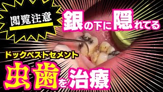 【虫歯治療】ドックベストセメントの治療の一部始終、お見せします