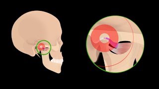 Боль в ушах из-за расстройства мозгового шва (TMJ)