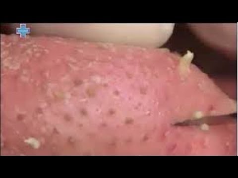 Removing Acne Easily | Acne Treatment