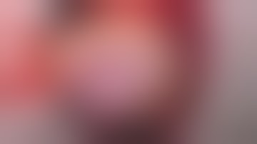 Repair of post-infarction multiple anterior muscular ventricular septal defects