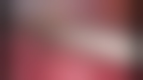 Laparoscopic Nephrectomy in Rt Xanthogranulomatous Pyelonephritis (XGPN)