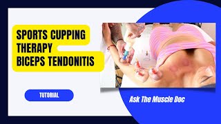 Dynamic Sports Cupping Therapy- Biceps Tendonitis Protocol- Ask The Muscle Doc Biceps Elbow Flexors Silicon Cupping Massage