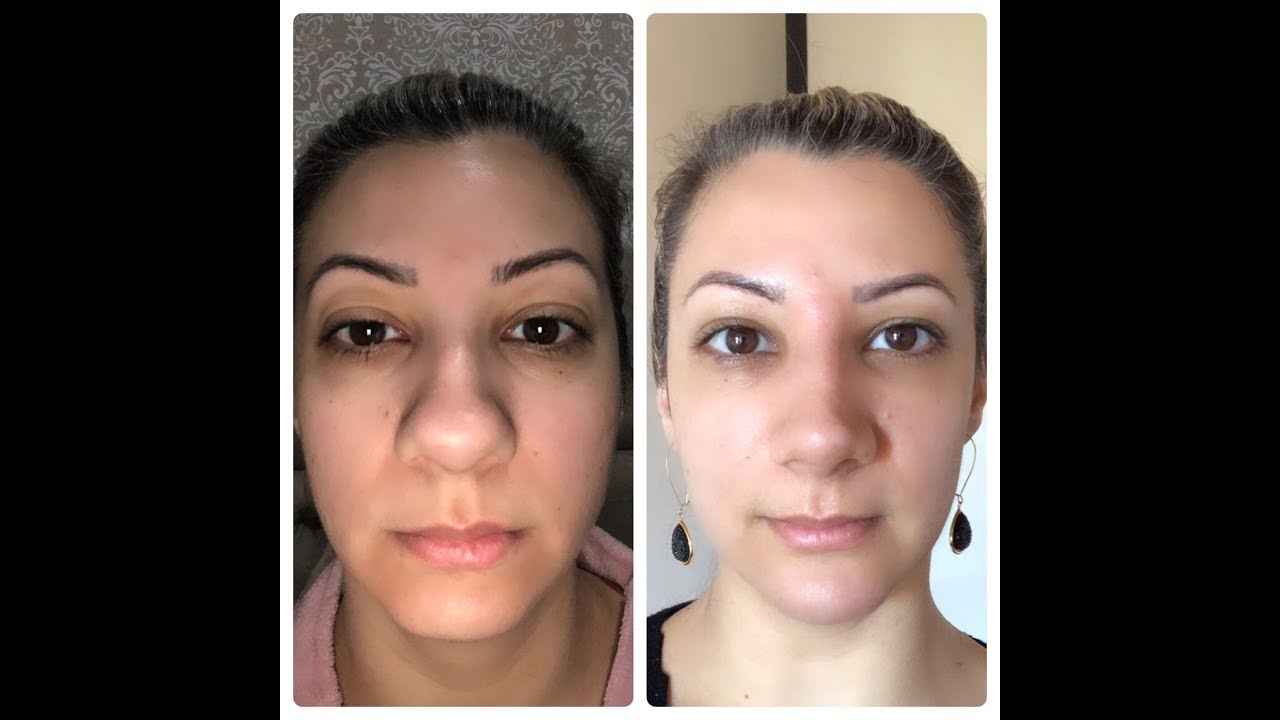 FIZ MINHA RINOPLASTIA!! VEM VER TODOS OS DETALHES (CENAS FORTES