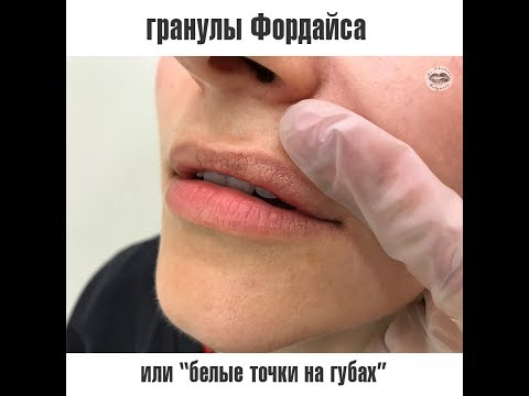 Гранулы Фордайса на губах