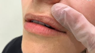 видео Белые точки на губах: причины появления, лечение