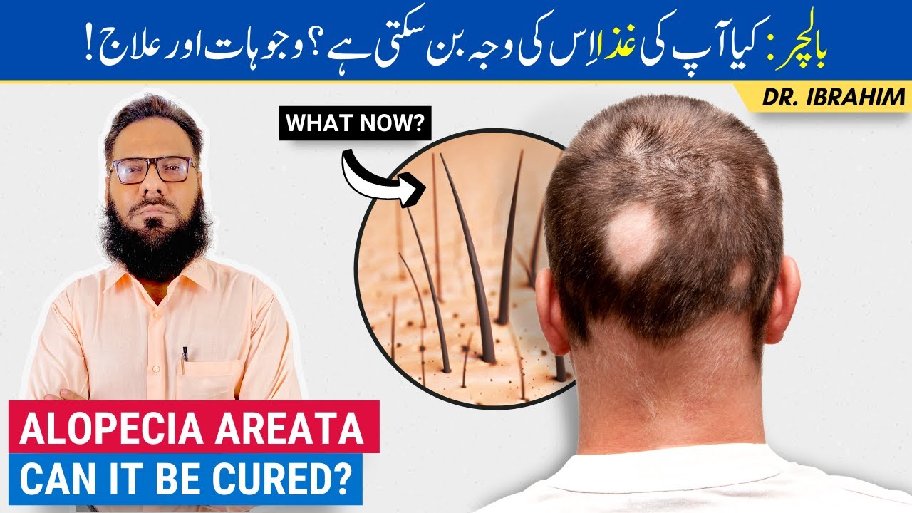 Balchar Ka Ilaj - Causes & Treatment of Alopecia Areata Through Herbal - Balo Ka Girna - Urdu/Hindi