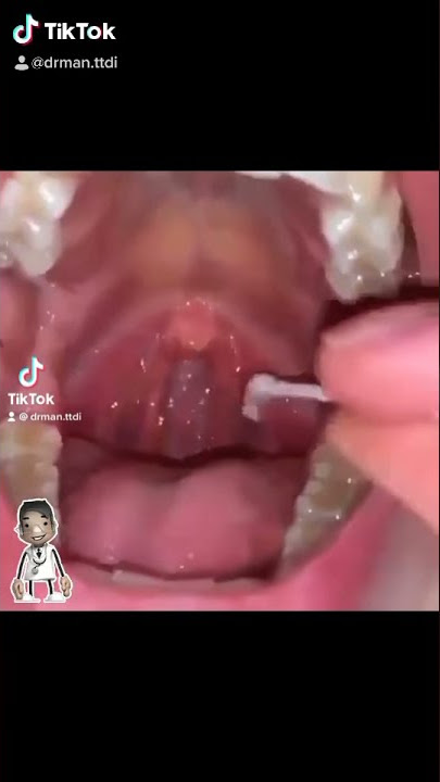 BATU KARANG CELAH TONSIL BUSUK - Story @DrManTtdi
