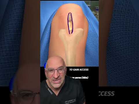 Bionic Leg Surgery Explained #shorts