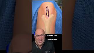 Bionic Leg Surgery Explained #shorts screenshot 2
