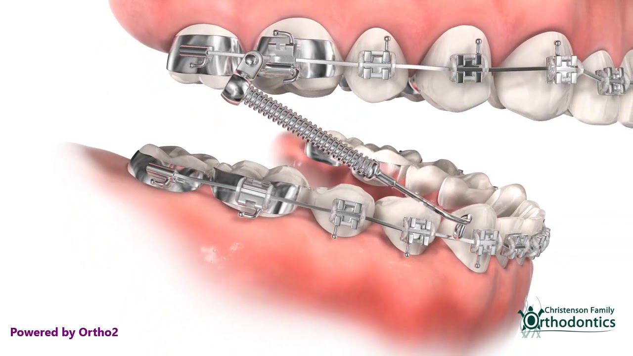 Orthodontic Appliances Explained