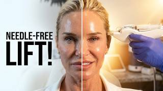 Get a Cat Eye Lift WITHOUT Surgery! Testing the Mesoject at PCH MedSpa