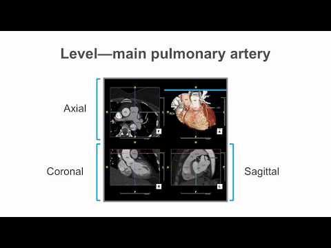 How to identify normal heart structures on a cardiac CT scan.