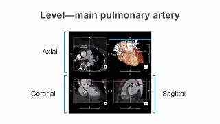 How to identify normal heart structures on a cardiac CT scan.