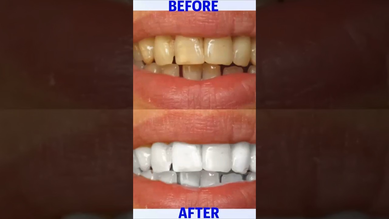 How To Whiten Your Teeth In Minutes!  Safe, simple, and effective.100%
