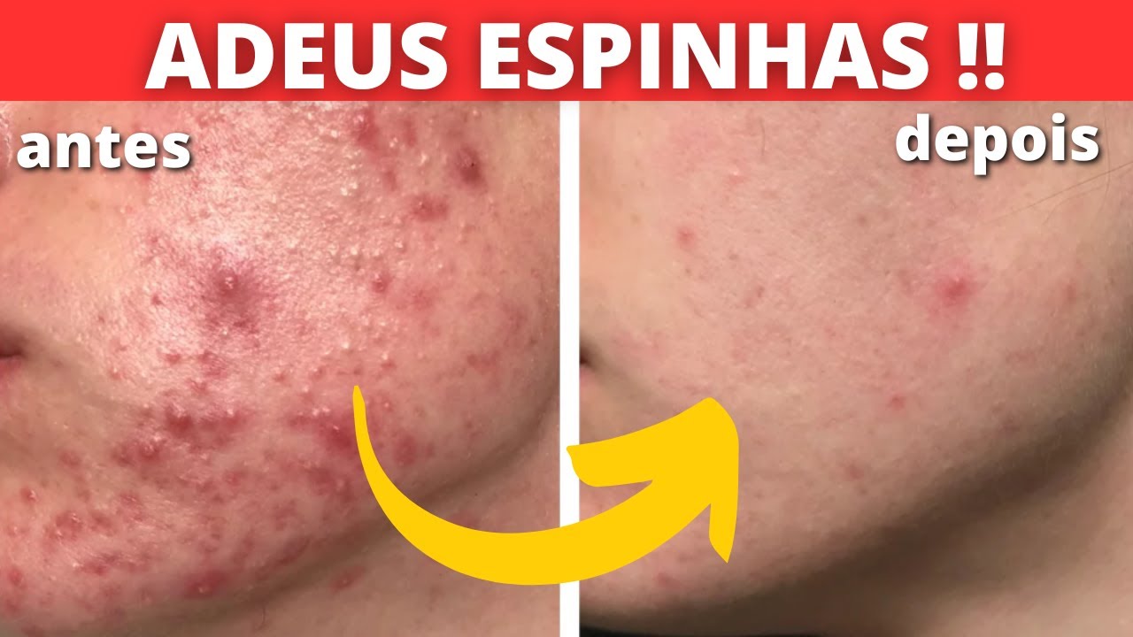 5 RECEITAS CASEIRAS PARA ACABAR DE VEZ COM CRAVOS E ESPINHAS! - YouTube