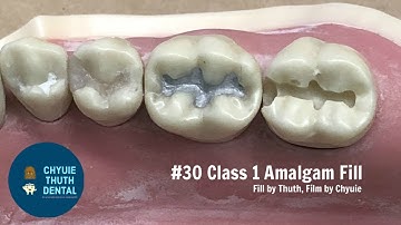 [ChyuieThuth] #30 Class 1 Amalgam Restoration