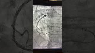 Mastering Complex Rca Cto Pci Full Step-By-Step Procedure