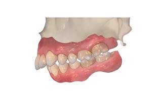 LeFort-IMDO-GenioPaully Jaw surgery