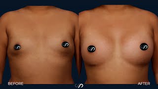 L.A. Natural Breast Augmentation | Los Angeles | Dr. David Stoker