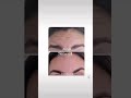 Botulinum toxin
