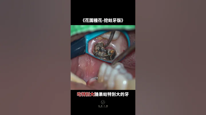 《花園種花-挖蛀牙版》推薦給不乖乖刷牙的小孩😏在小小的牙齒裡面挖呀挖呀挖｜【祐民牙醫－隱適美旗艦店】#花園種花 #小小花園 #挖呀挖呀挖 #蛀牙 - 天天要聞