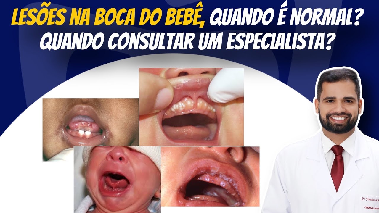 Bolinhas brancas na boca do bebê, é normal? #pediatria #bebê #lesão ...