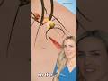 Doctor reacts: ant stitches?! @zackdfilms