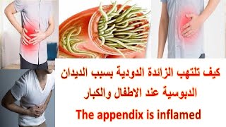 كيف تلتهب الزائدة الدودية بسبب الديدان الدبوسية عند الاطفال والكبار2021  The appendix is ​​inflamed