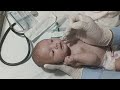 How to Pass NG Tube &amp; Perform Stomach Wash in a Critical Baby | NICU Emergency Procedure