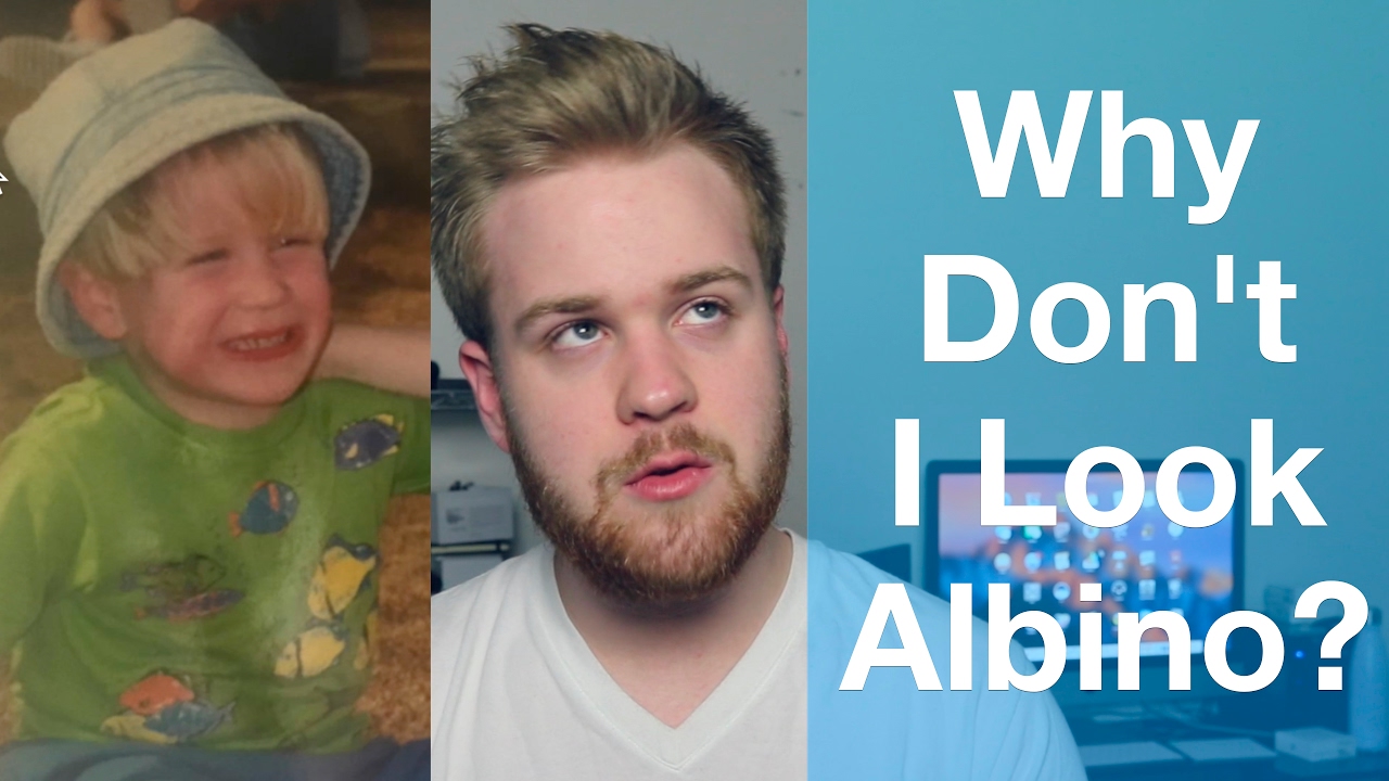 Why I Don't Look ALBINO but Do Have ALBINISM! - YouTube