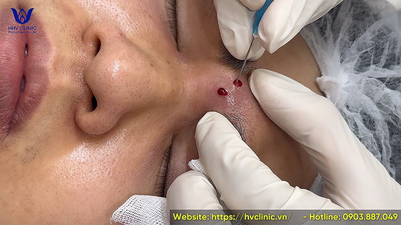 Nặn mụn nhọt áp xe ở trán, mụn sưng viêm căng cứng.