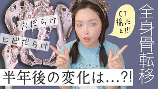 【乳がん全身骨転移】近況報告します!