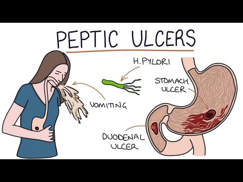 Peptic Ulser | Stomach and Duodenal Ulsers | Drk