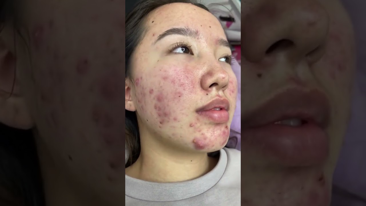 Тяжелая форма акне #доипосле #акнекутан
