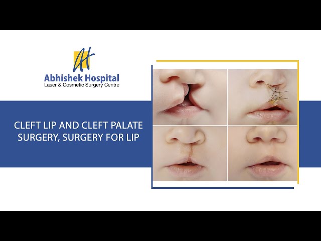 Cleft Lip and Cleft Palate Surgery, Surgery for Lip (in Hindi)