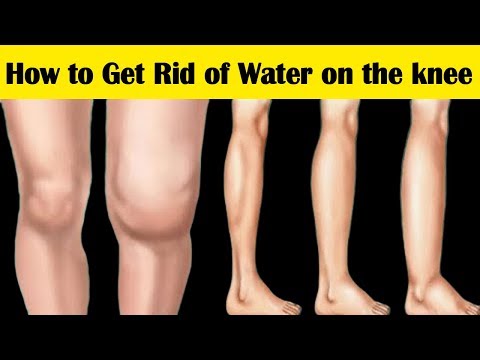 How to Get Rid of Water on the Knee || 6 Home Remedies for Water on the Knee Symptoms