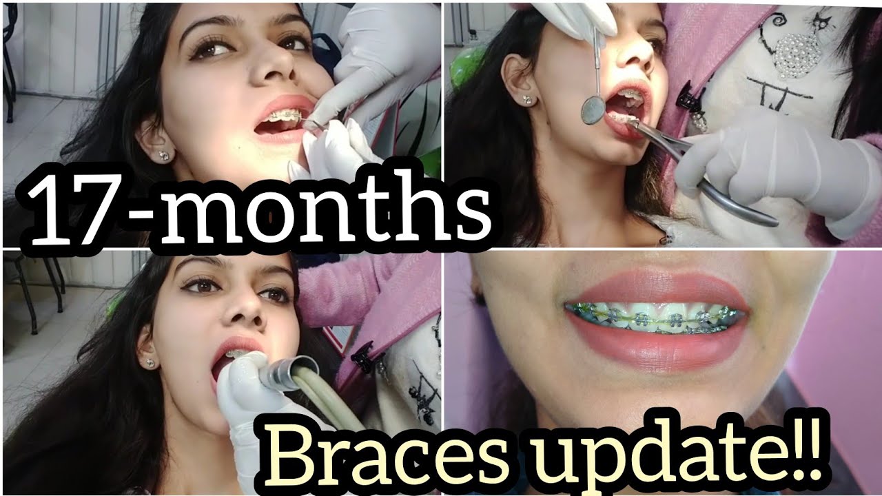 17months BRACES update!!/braces tightening vlog!/braces 