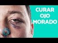 OJO MORADO - QUITAR MORETN en el OJO RPIDAMENTE