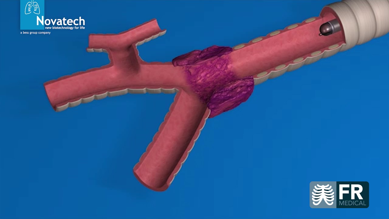 STENT SILICON Y FRMEDICAL NOVATECH MEXICO TRAQUEA YouTube