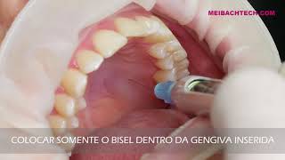 Visíveis mole veias palato
