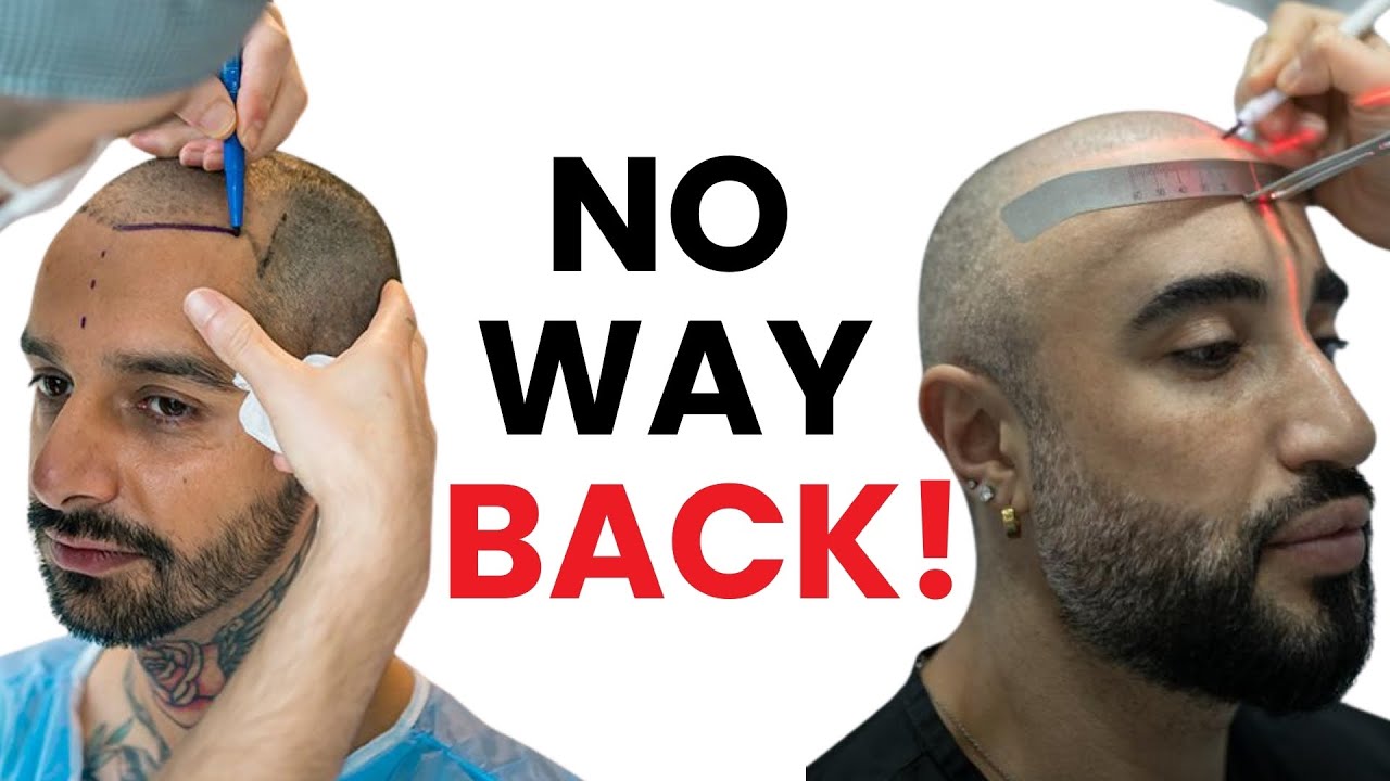 3 Hair Transplant Red Flags To Never Ignore!