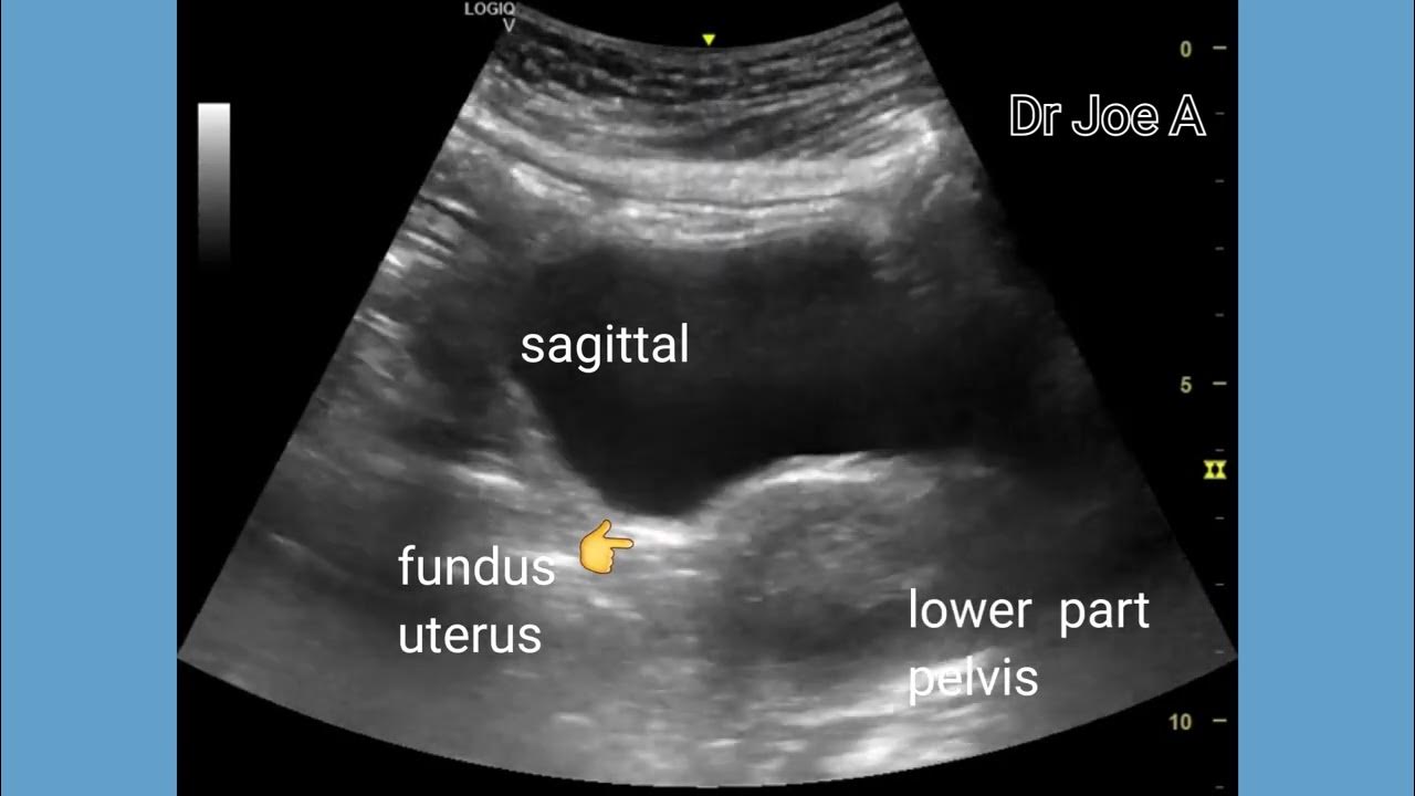 uterine-prolapse-with-cystocele-of-urinary-bladder-ultrasound-video