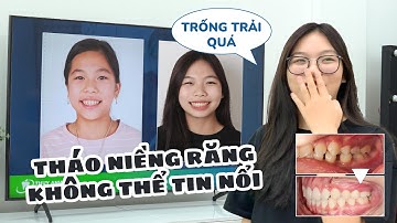 15 Tuổi Đã Niềng Răng Xong - Độ Tuổi Thích Hợp Nhất Để Niềng Răng