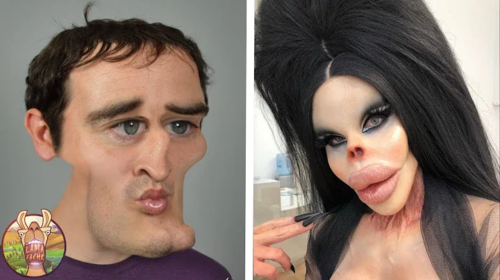 Personnes Qui Ont Abuss Avec La Chirurgie Esthtiqu...