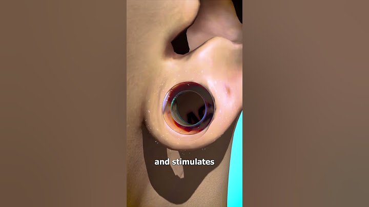 How Ear Gauges Can Tear Your Ears 👂