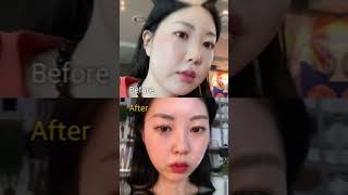 놀람주의) 얼굴지방흡입+리프팅 역대급 후기사진 #얼굴지흡 #성형후기 #리프팅후기