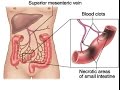 Mesenteric Ischemia